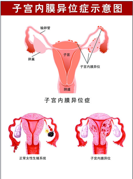 子宫内膜薄_始基子宫会长内膜吗_正常子宫宫内膜厚度