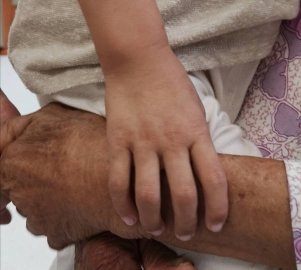 深圳2岁半男童2000多度近视、驼背、消瘦,经基因检测确诊为“天才病”