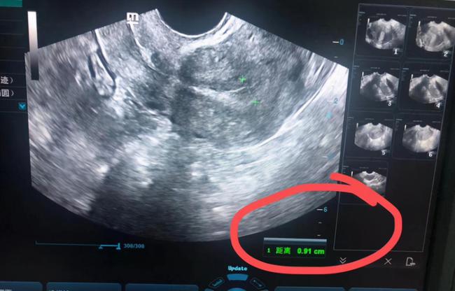 子宫n内膜弥漫型小息肉_子宫内膜薄_子宫 内膜 息肉