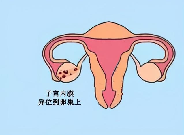 巧克力 囊肿_卵巢巧克力样囊肿_巧克力囊肿