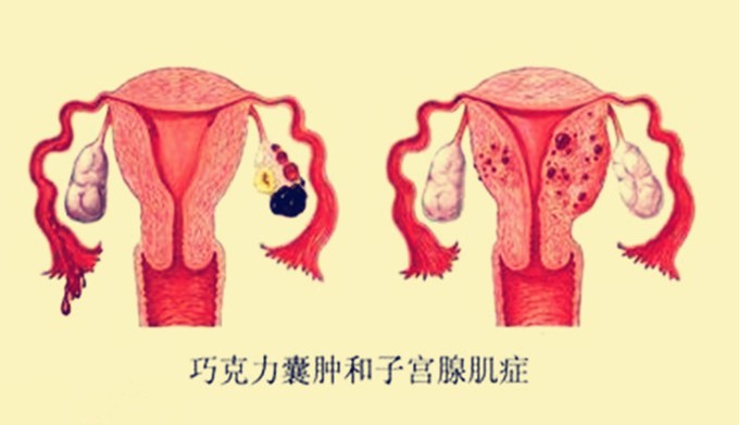 卵巢巧克力样囊肿_巧克力 囊肿_巧克力囊肿