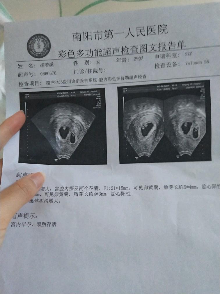 双胞胎怎么生_怎么生双胞胎_如何能生同卵双胞胎