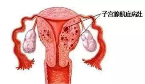 子宫腺肌症_子宫腺肌症子宫腺肌瘤_子宫腺肌症的治疗