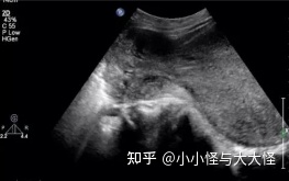 子宫内膜薄