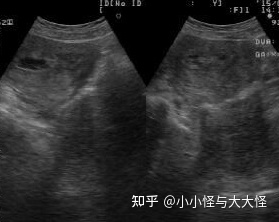 子宫内膜薄