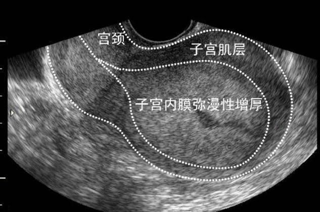 子宫内膜薄_内膜正常子宫会粘连_幼稚子宫 内膜显示不清