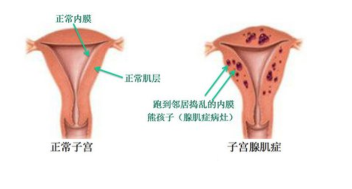 子宫腺肌症_什么是子宫腺肌症_子宫腺肌症症如何受孕