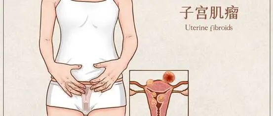子宫腺肌症_什么是子宫腺肌症_子宫腺肌症症如何受孕