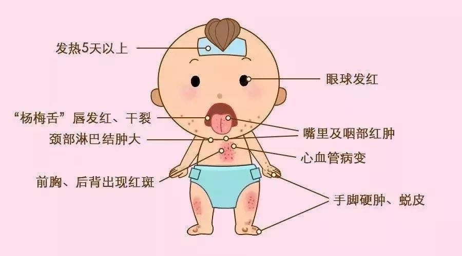 幼儿急疹图片症状_幼儿急疹_幼儿急疹的症状与治疗