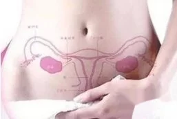 子宫腺肌症