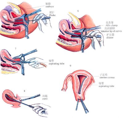子宫内膜薄_子宫双层内膜厚度多少正常_闭经,子宫偏小内膜0.5