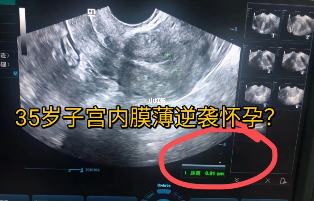 闭经,子宫偏小内膜0.5_子宫双层内膜厚度多少正常_子宫内膜薄