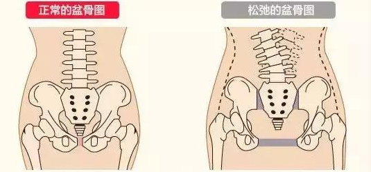 盆底肌康复_医院盆底肌修复怎么做_盆底肌修复