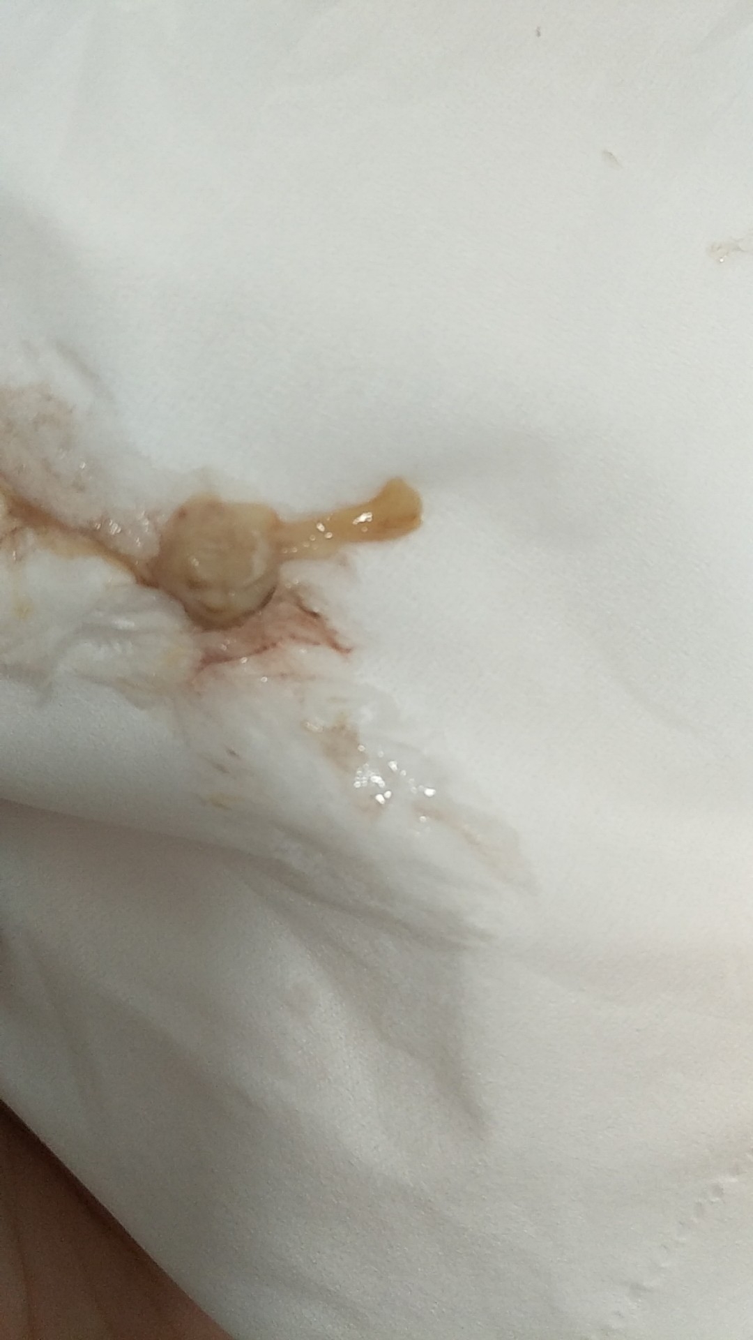 产后恶露_产后恶露反复_产后恶露