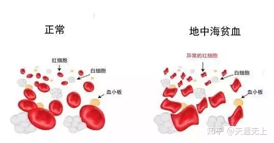 地海中贫血有哪些症状_地中海贫血_地海中贫血能要小孩吗?