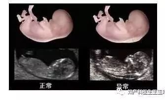想做NT检查,需要注意什么?(图1) nt检查