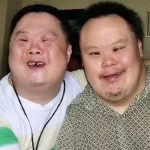 先天愚型 唐氏综合_假日综合征和症_唐氏综合症