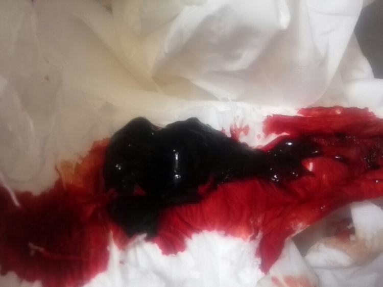 产后恶露不尽_产后恶露_产后恶露反复