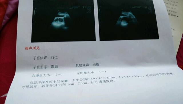 双胞胎还能生二胎吗_怎么生双胞胎_头胎双胞胎能生二胎吗
