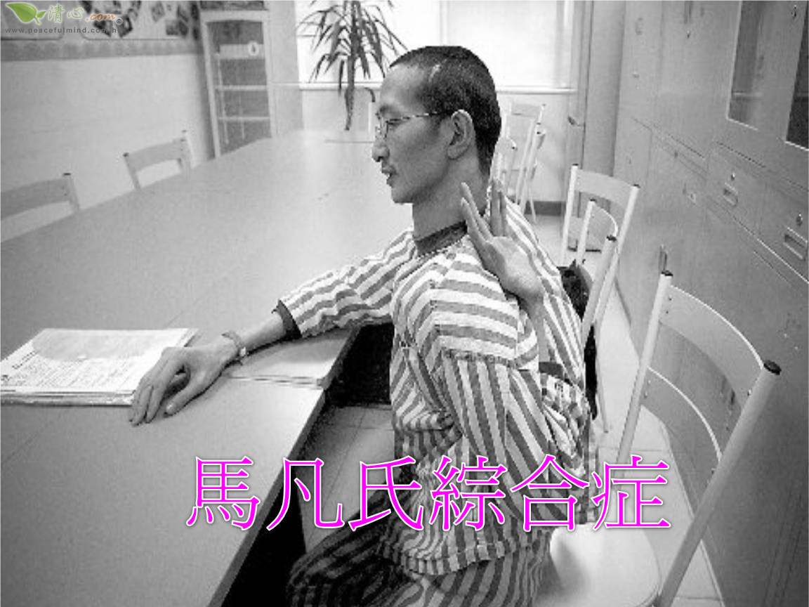 柯兴氏综合症是特别胖吗_马凡氏综合症_卓艾氏综合症是癌症吗