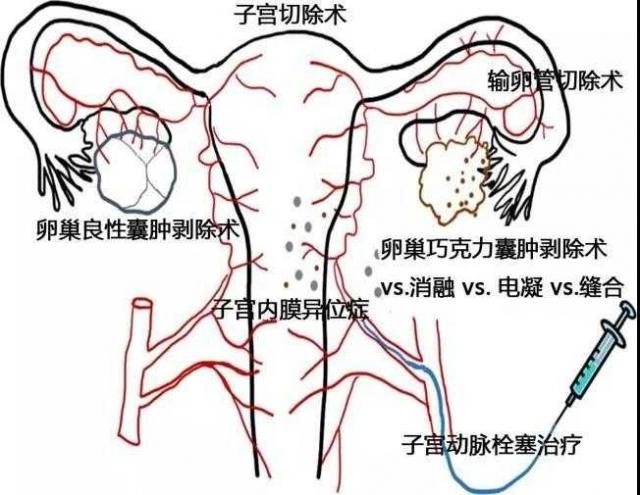 窦卵泡计数_卵泡与卵泡囊肿_有卵泡不排卵泡会变成什么