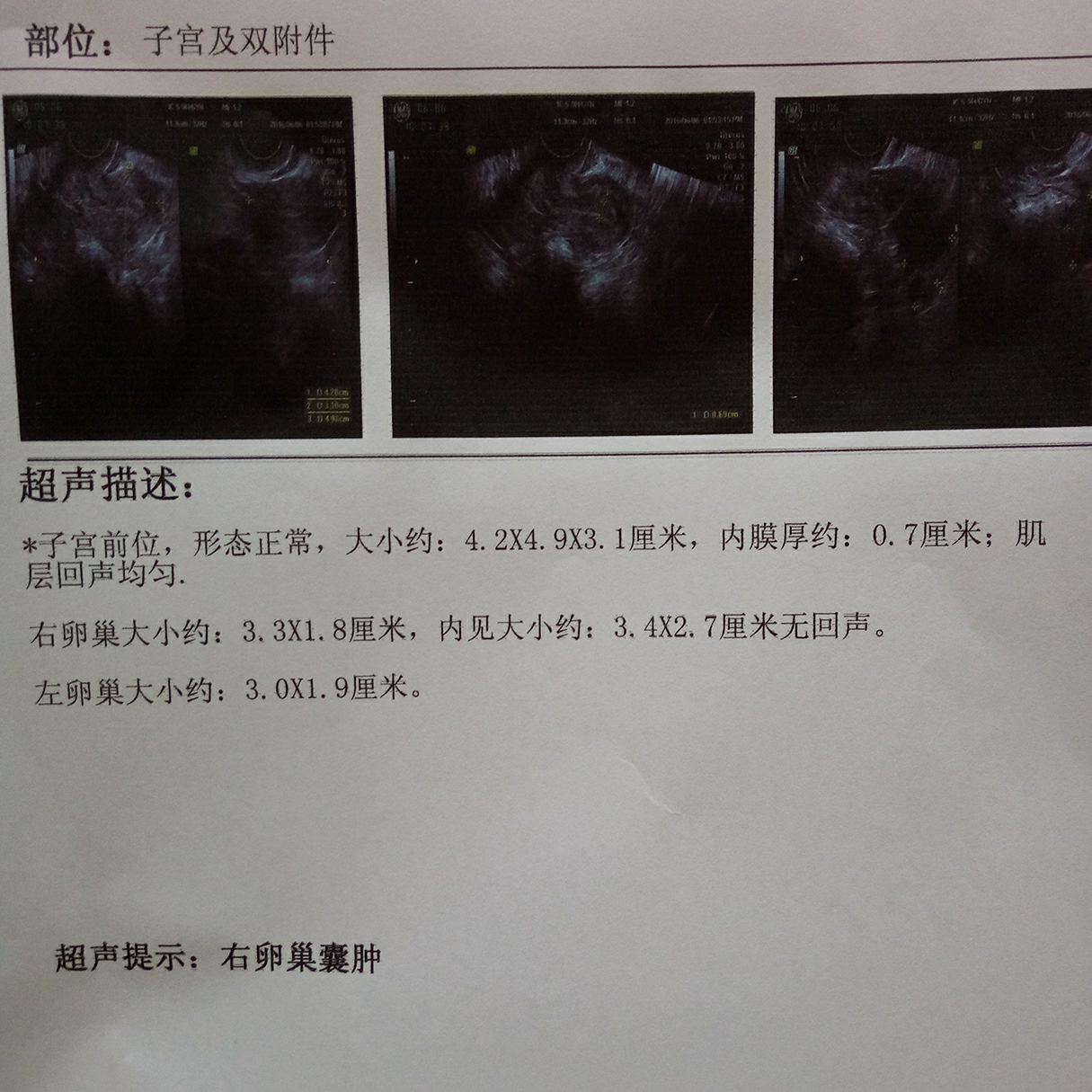 穿刺大卵泡,小卵泡能长大吗_窦卵泡计数_有卵泡不排卵泡会变成什么