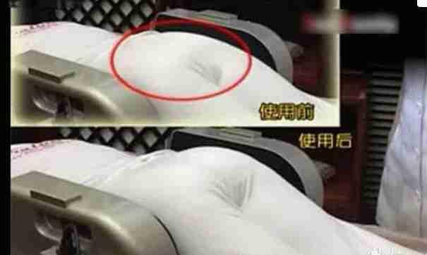 盆底肌修复