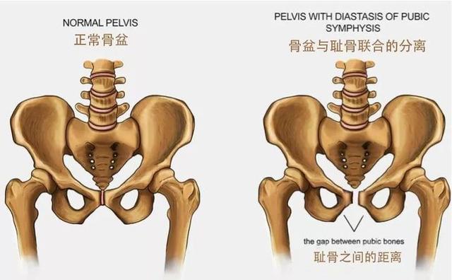 盆底肌修复