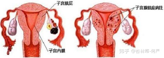 子宫腺肌症