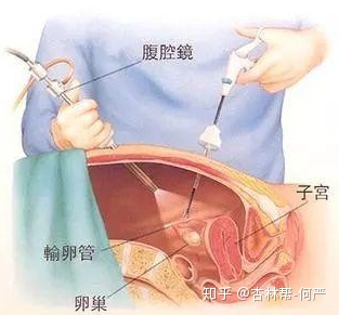 子宫腺肌症