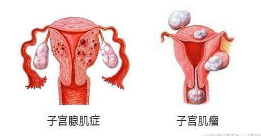 什么是子宫腺肌症_子宫腺肌症_子宫肌腺症 子宫腺肌症