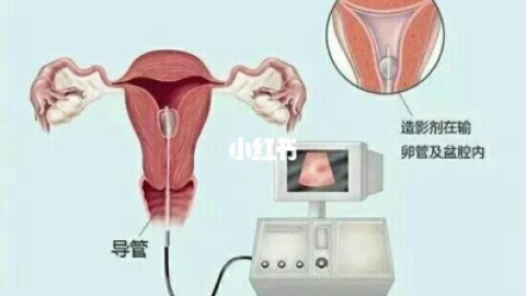 女性不孕一定要做输卵管造影检查吗？输卵管造影检查后可能会带来