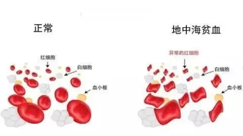 【5.8世界地贫日】专题一：地中海贫血可防可控