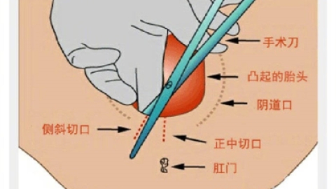关于侧切你了解多少？