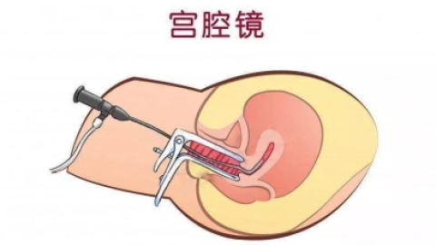 宫腔镜——子宫环境的“照妖镜”
