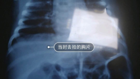 辟谣丨亲身经历，新生儿咳嗽、呛奶、吐泡泡不一定是肺炎！