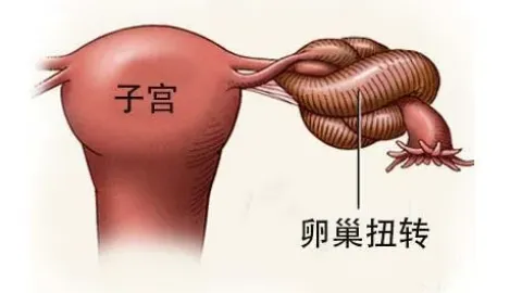 > 卵巢巧克力囊肿会扭转吗?
