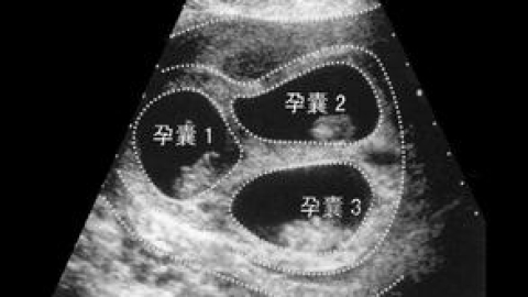 双（多）胎妊娠的几件“P”事