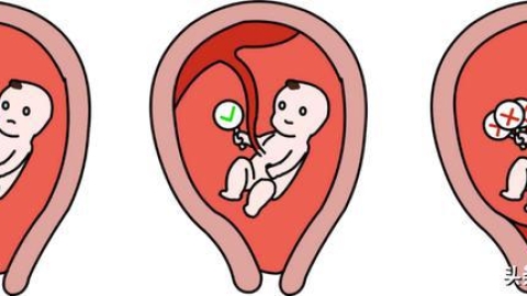 什么是多胎妊娠？