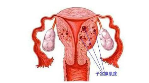子宫腺肌病,子宫腺肌病如何治疗,子宫腺肌病症状