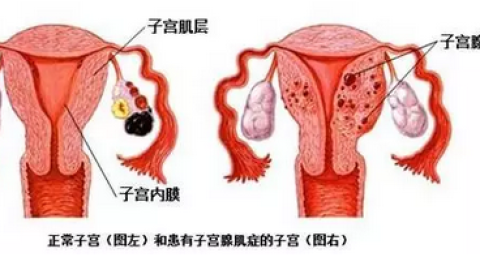 子宫腺肌病最新指南