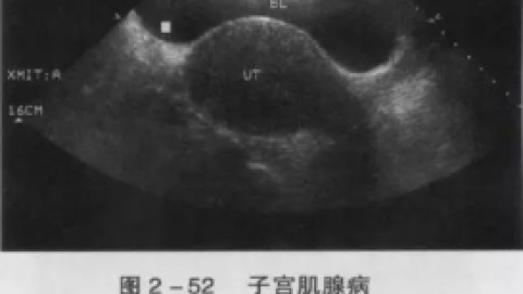 子宫腺肌病到底是个什么病？图片真的血腥！