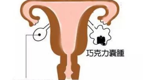 预防巧克力囊肿方法都有哪些