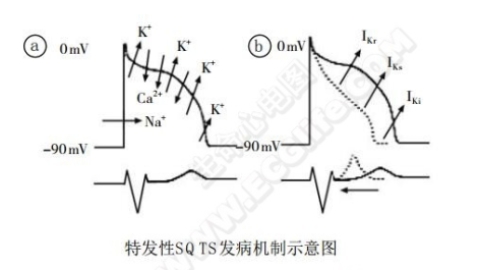 短QT综合征（短QT间期综合征、SQTS）(心血管 经典心电