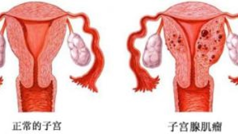 子宫腺肌病三大治疗方案！