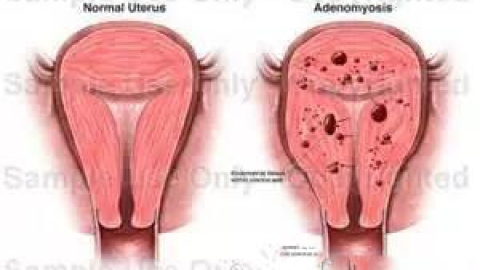 介入治疗子宫肌瘤及子宫腺肌症