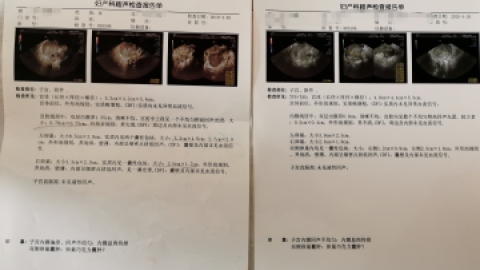 巧克力囊肿斗争史