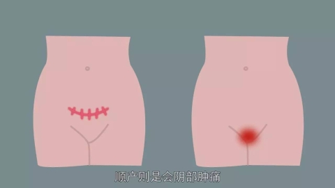 女人顺产生孩子会阴侧切全过程（图片）