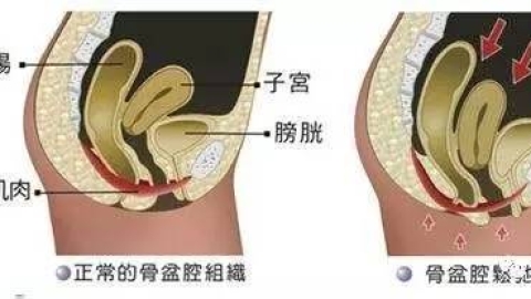 多胎妊娠分娩期应该注意什么