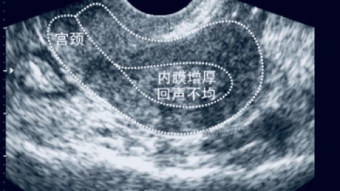 子宫内膜多厚才算正常呢